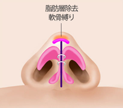 韓国団子鼻整形