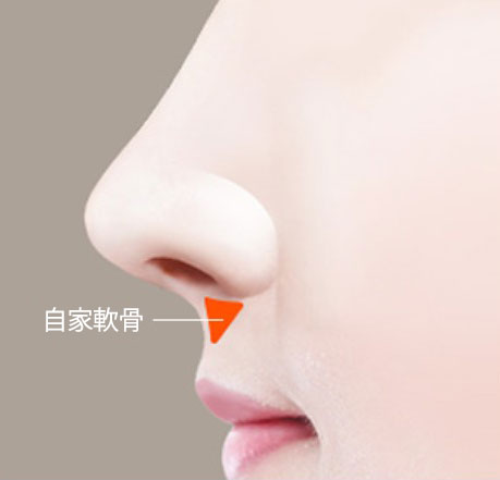 韓国鼻柱整形