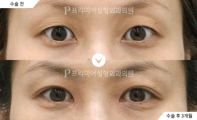 上眼瞼＋目つき矯正＋目頭切開＋瞼脂肪移植